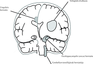 fokozott koponyaűri nyomás hipertónia