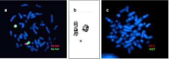 Három különböző kromoszóma vizsgálat fluoreszcens jelöléssel, Xq és Xp karok, SE X és XIST jelölések.