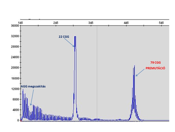 Genetikai grafikon, amely a CGG ismétlődések számát mutatja, 22 CGG és 79 CGG premutációval.