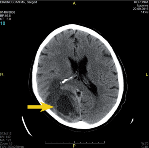 CT felvétel az agyról, sárga nyíl jelzi az elváltozást, orvosi diagnosztika