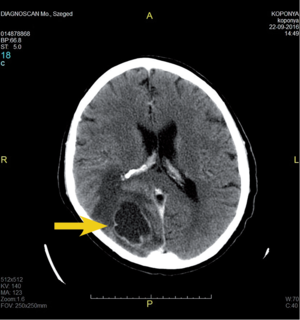 CT felvétel az agyról, sötét folttal jelzett elváltozás Szegeden, 2016