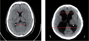 CT agyi felvétel piros vonalakkal Két CT agyi felvétel, piros vonalakkal jelzett mérésekkel.