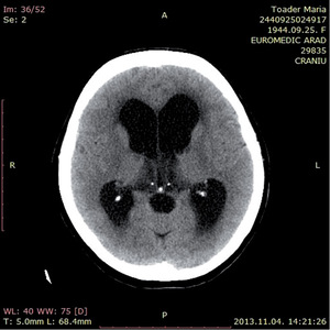 CT felvétel az agyról - Toader Maria CT felvétel az agyról, Toader Maria, Euromedic Arad, 2013.11.04.