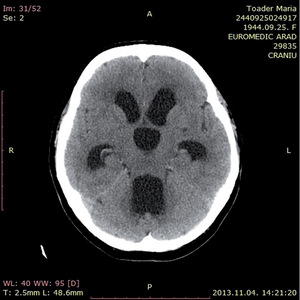 CT felvétel az emberi agyról - Toader Maria CT felvétel, amely Toader Maria agyát ábrázolja, Euromedic Arad, 2013.11.04.