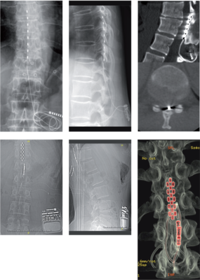 Röntgenfelvételek a gerinc stimulátor beültetéséről, különböző nézetekben.