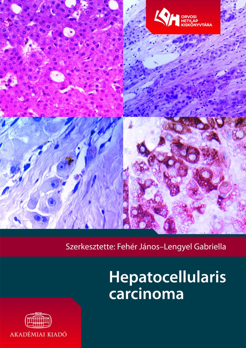 Hepatocellularis carcinoma