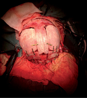 Orvosi műtét során felnyitott koponya, fém csavarokkal rögzítve.