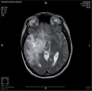 MRI felvétel egy emberi koponyáról, amelyet a Diagnoscan Mo Szeged készített 2015. december 20-án.