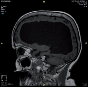 MRI felvétel egy emberi koponyáról oldalnézetben MRI felvétel egy emberi koponyáról oldalnézetben, Szeged, 2013