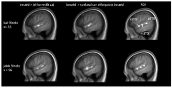 MRI felvételek az agy különböző területeiről beszéd feldolgozás közben, jelmagyarázattal.