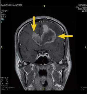 MRI felvétel, amelyen egy agydaganat látható, sárga nyilakkal megjelölve.