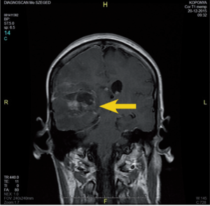 MRI felvétel, amelyen egy agyi elváltozás látható, sárga nyíllal megjelölve. Diagnosztikai kép Szegedről.