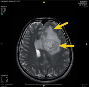 MRI felvétel az agyról, amely egy elváltozást mutat Szegeden, jelmagyarázattal.