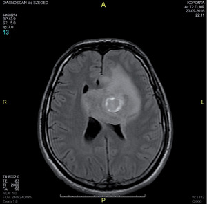 MRI felvétel az agyról, amelyen egy elváltozás látható, diagnosztikai célra.
