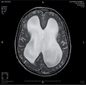 MRI agyi felvétel a koponya keresztmetszetéről MRI felvétel az emberi agyról, koponya keresztmetszet, Szeged, Ax T2 FRFSE