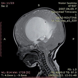 MRI felvétel koponyáról elváltozással MRI felvétel egy emberi koponyáról, amelyen egy nagy méretű elváltozás vagy tumor látható.