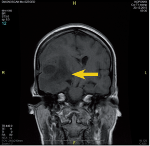 MRI felvétel az emberi koponyáról, sárga nyíl jelzi a vizsgált területet.