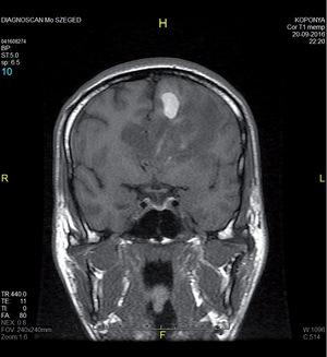 MRI felvétel egy emberi koponyáról, Diagnoscan Mo Szeged, 2016.09.20.