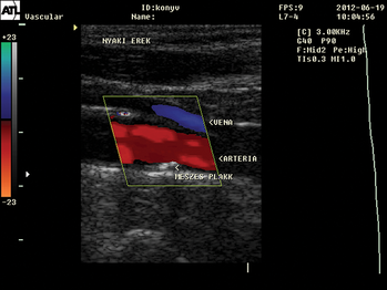 Nyaki erek ultrahang vizsgálat, Doppler képpel, vénák, artériák és meszes plakk látható.