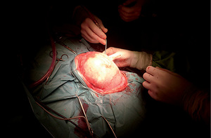 Sebészeti beavatkozás, ahol orvosok műtétet végeznek egy páciensen