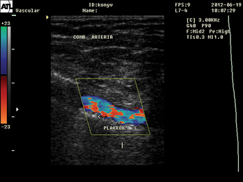 Ultrahangos érvizsgálat képe a comb artériáról, plakkokkal, különböző színű jelölésekkel.